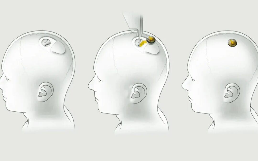 Promé implante di Neuralink den ser humano ta un echo